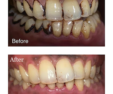 Deep Cleaning & Scaling — before and after
