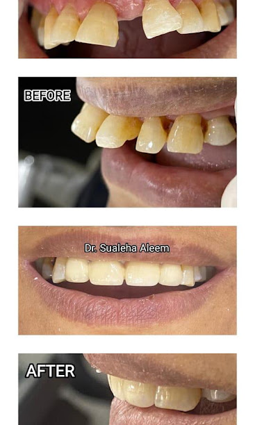 Smile Makeover — before and after