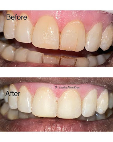 Crown & Veneer — before and after