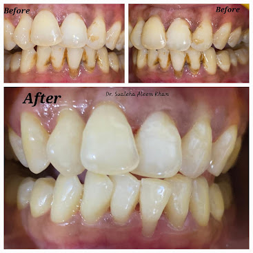 Alignment Correction — before and after